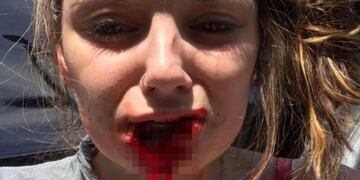 Le arrancó parte del labio (Web)