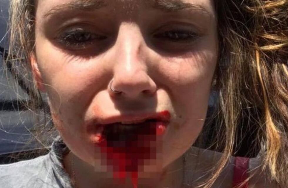 Su novio le arrancó un pedazo de labio para "dejar su marca"