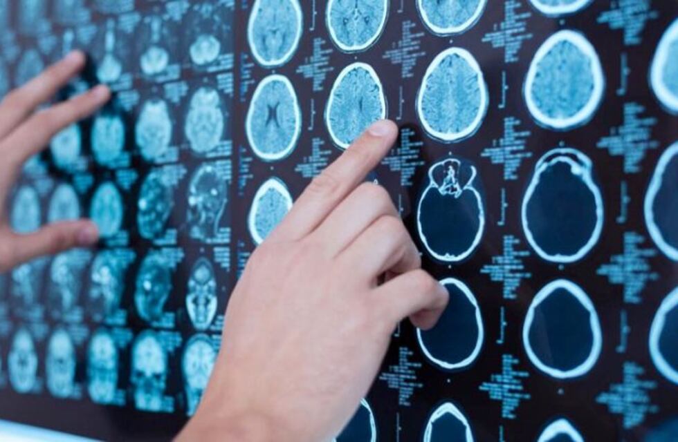 Jornada sobre el Accidente Cerebro Vascular en el Hospital Molas de Santa Rosa