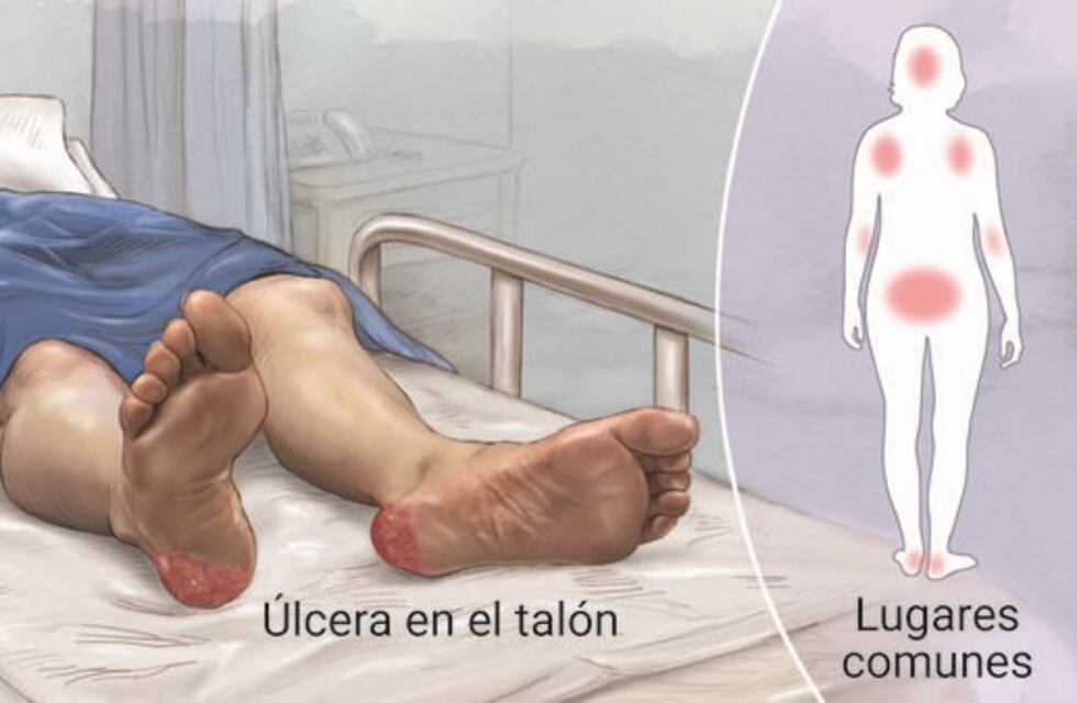 Cómo evitar úlceras en la piel de pacientes durante una internación larga