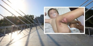 Niño quemado en el nuevo puente petaonal