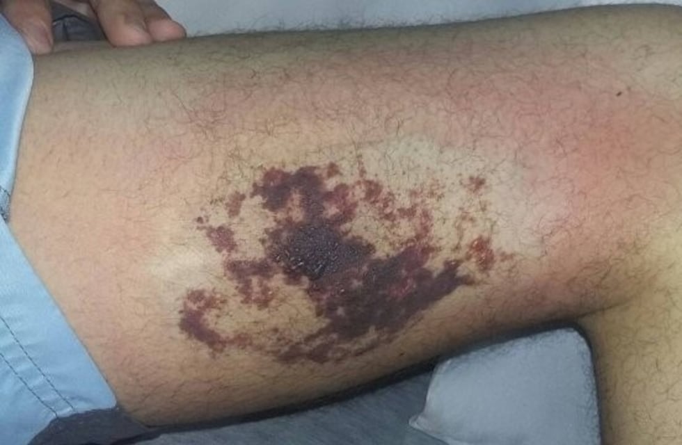 Alerta por arañas de rincón: una mujer embarazada debió ser hospitalizada en el sur santafesino
