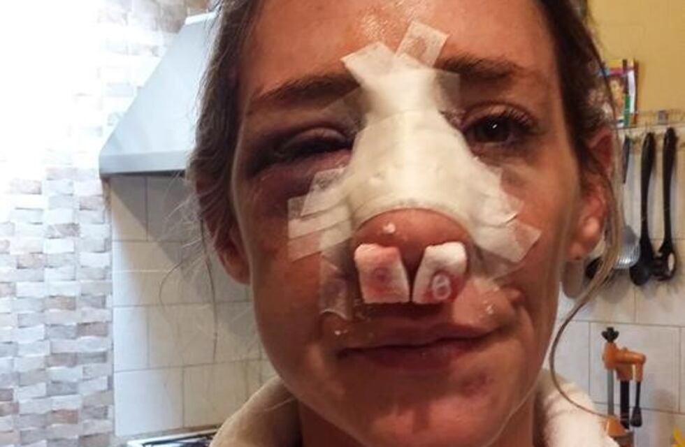 Violencia de género: estaban separados, lo perdonó y él le desfiguró el rostro