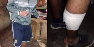 Así quedó la pierna de Ricardo Banegas, el sanjuanino que recibió el disparo\u002E