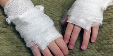 Quemaduras por uso de pirotecnia: un arma mortal al alcance de todos\u002E (Web)\u002E