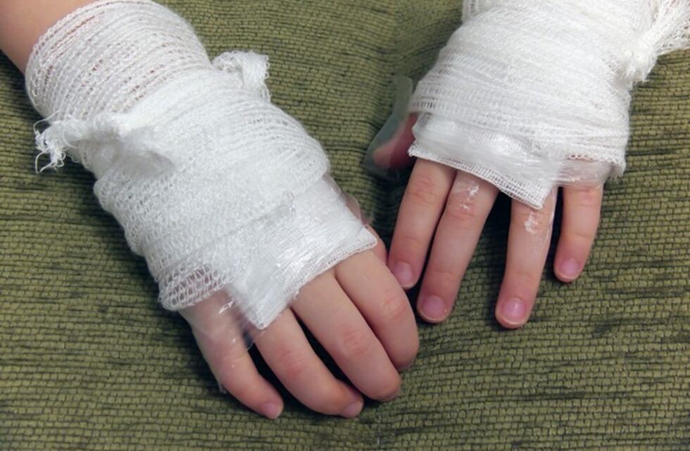 Navidad: trece personas con lesiones leves en el hospital del Quemado por el uso de pirotecnia