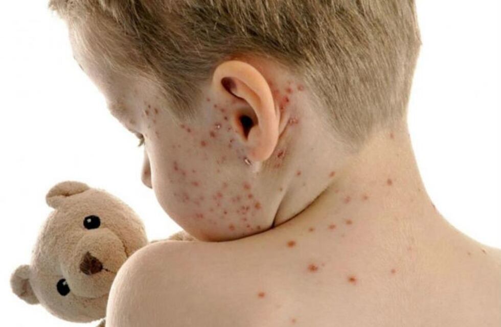 En primavera, también florecen las enfermedades eruptivas en los más chicos