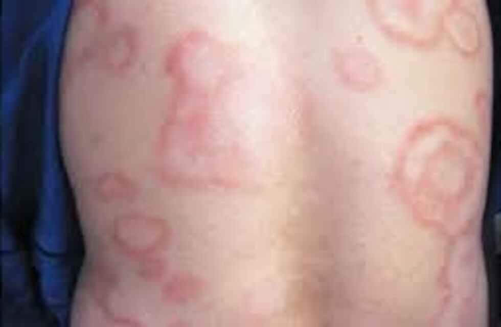 Recomiendan prestar atención a algunos síntomas de la lepra