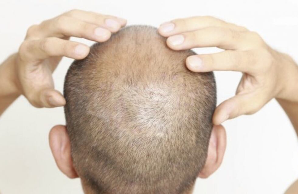 Descubren un fármaco que podría curar la calvicie