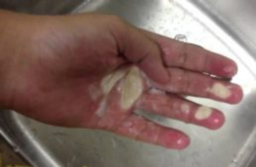 El nuevo desafío viral que causa graves quemaduras
