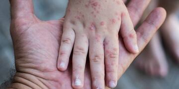 Sarampión\u002E (Foto: Web)