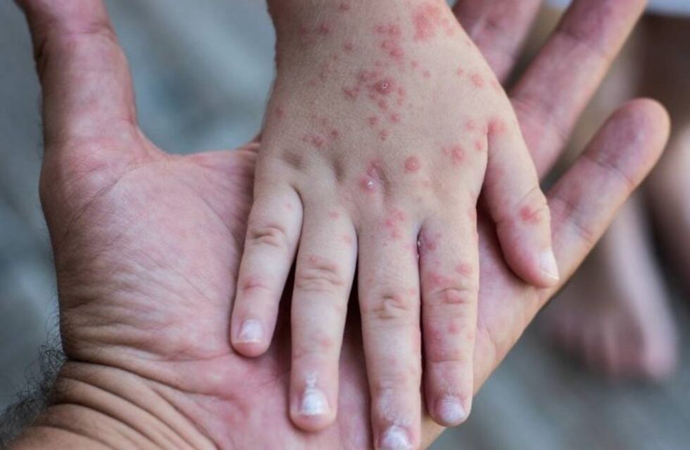 Una mujer antivacunas y sus cinco hijos, los últimos casos confirmados del brote de Sarampión
