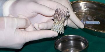 Se llevó a cabo un implante aórtico en Comodoro