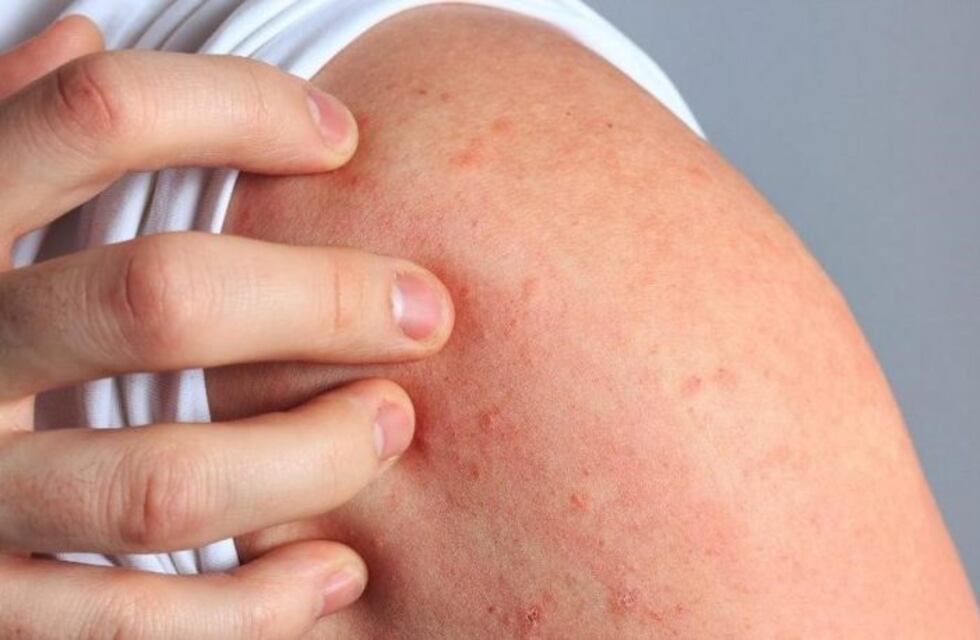 Charla gratuita sobre "Dermatitis atópica" vía zoom