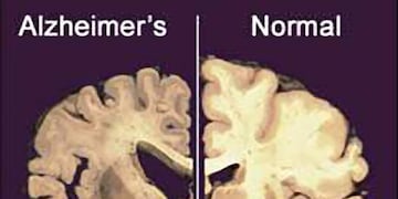 Esta imagen sin fechar suministrada por Merck & Co., muestra la secciu00f3n transversal de un cerebro normal a la derecha y la de un cerebro dau00f1ado por la enfermedad de Alzheimer a la izquierda. (Foto AP/Merck & Co./Archivo) eeuu enfermedad de Alzheimer tomografia imagen seccion transversal de un cerebro normal primeros experimentos estadounidenses con marcapasos cerebral