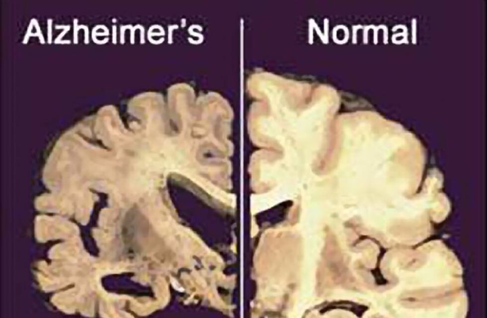 Científicos logran prevenir Alzheimer en ratones