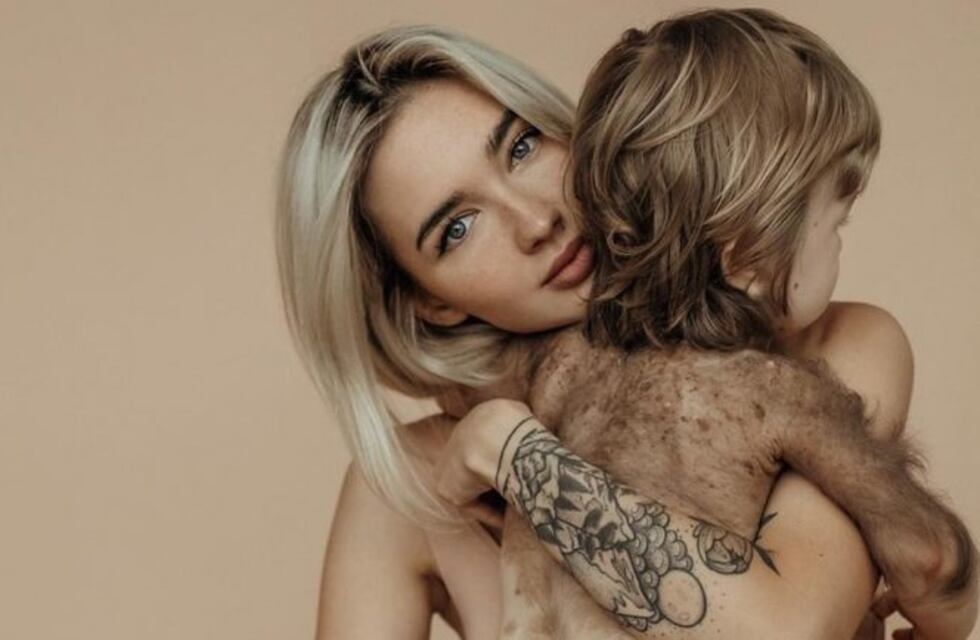 Una influencer rusa mostró la extraña enfermedad que padece su hijo en la piel