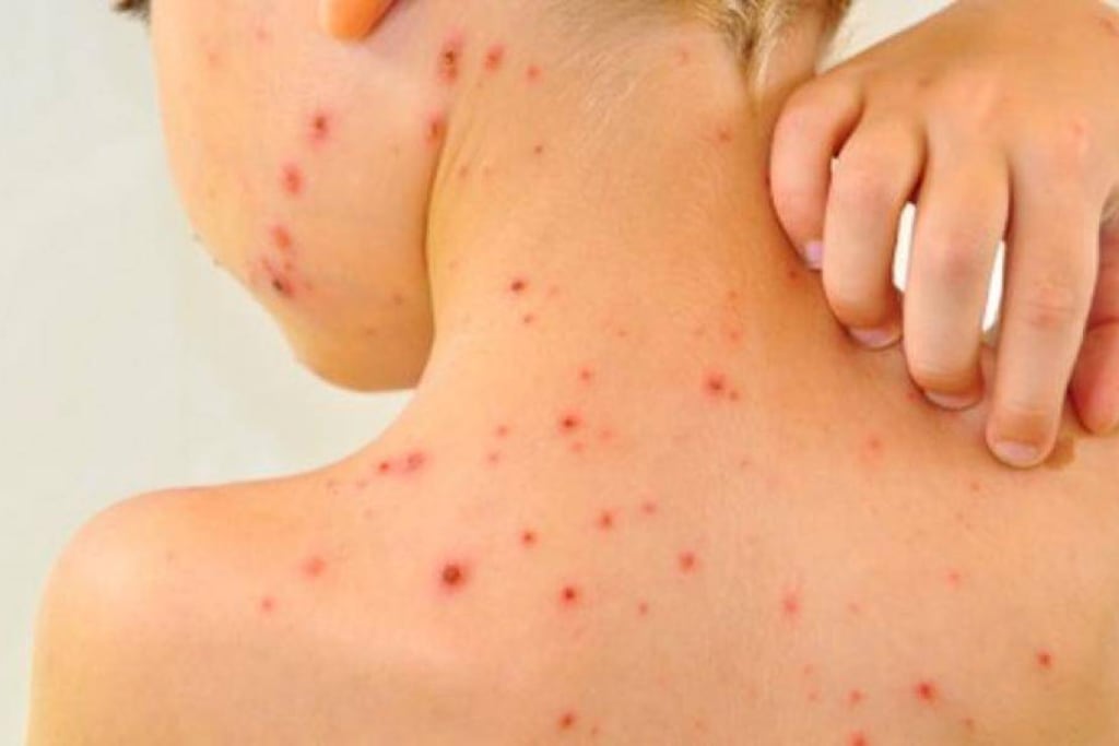Detectaron un rebrote de varicela y llaman a extremar cuidados