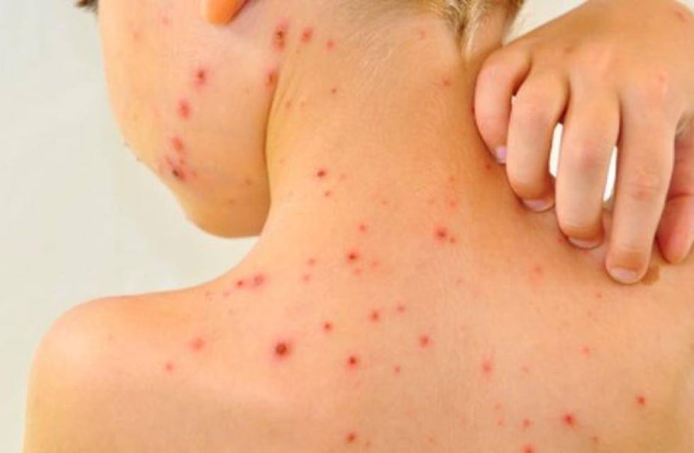 Alerta en Gualeguaychú: detectaron un rebrote de varicela y llaman a extremar cuidados