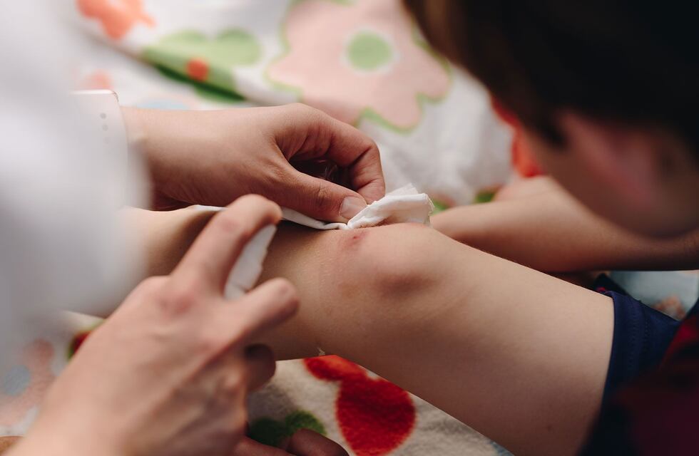 En un mes y medio en el Materno Infantil de Salta atendieron a 40 niños con quemaduras