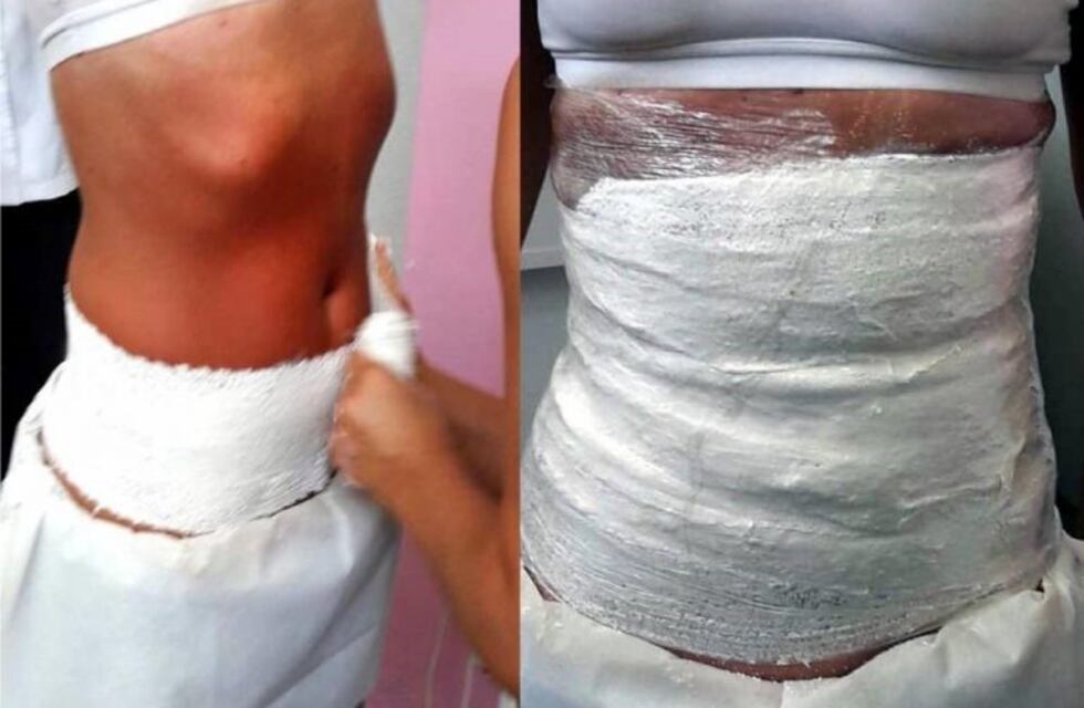 Ya llegó a Mendoza la moda polémica de enyesarse el cuerpo