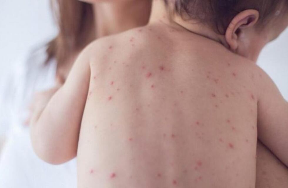 Sarampión: advirtieron que "el mayor riesgo es que haya más casos"