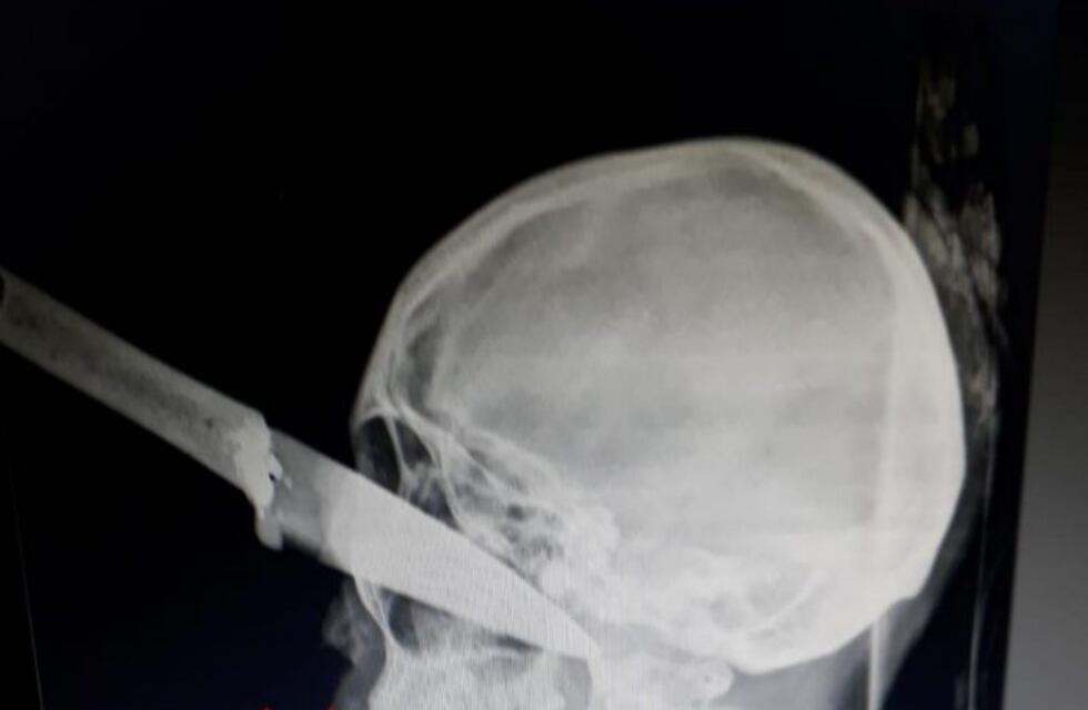 Cuatro mujeres patotearon y le clavaron un cuchillo en el ojo a una vecina