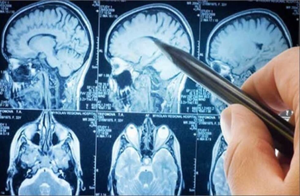 Crean un interruptor para controlar los ataques de epilepsia