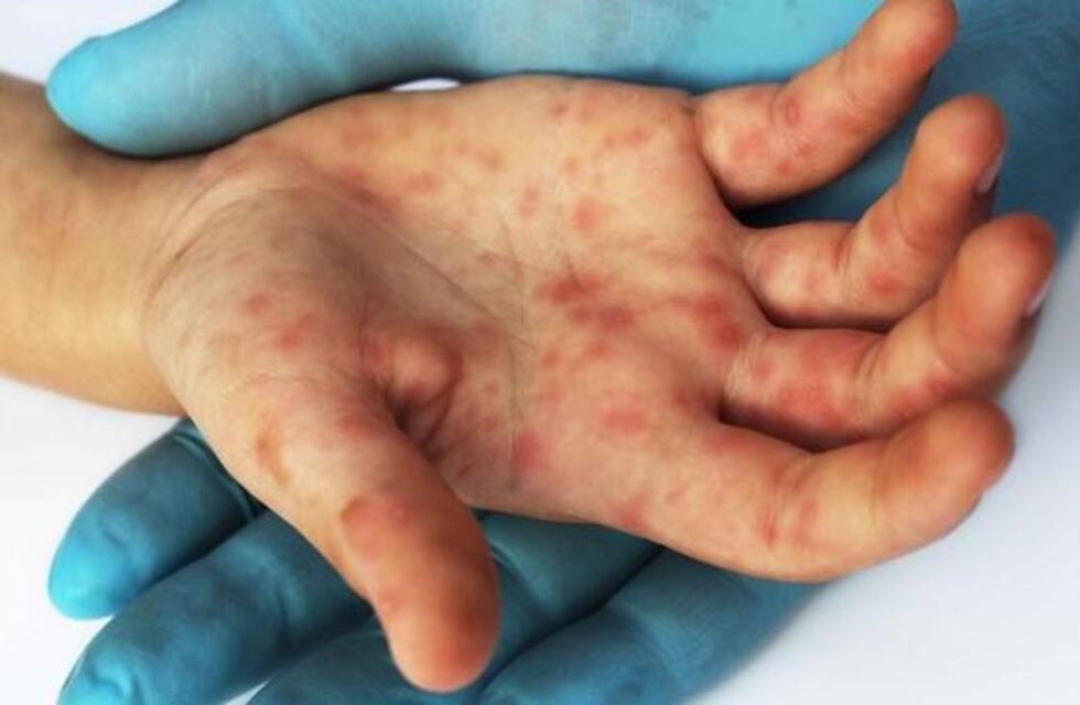 Nena de 8 años, muere por Sarampión luego de que su padre se negara a vacunarla: qué dijo el hombre