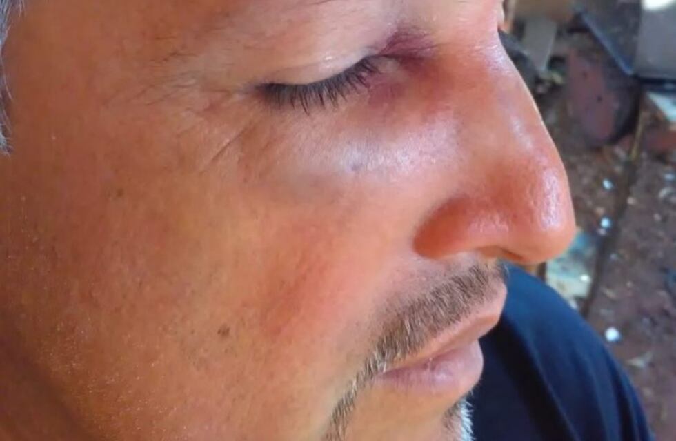 Árbitro con la nariz rota por un jugador que lo golpeó