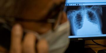 An X-ray of a patient suffering from the coronavirus disease (COVID-19) is seen as a doctor briefs his relatives about his medical condition, at the Max Smart Super Speciality Hospital in New Delhi, India, September 5, 2020\u002E Picture taken September 5, 2020\u002E REUTERS/Danish Siddiqui