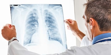 Cáncer de pulmón