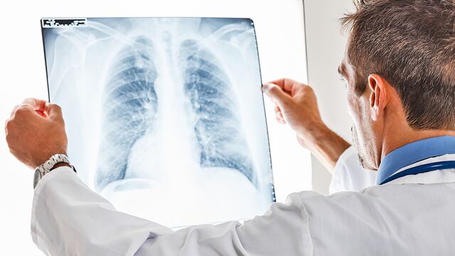 Cáncer de pulmón