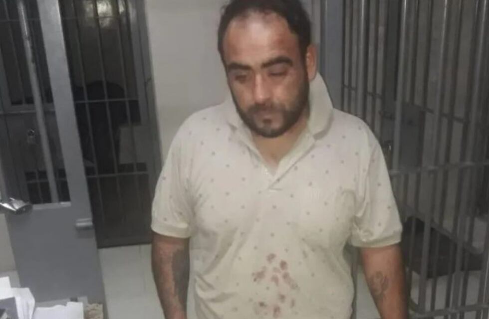 Atacó a su pareja a mordiscones y le arrancó parte del labio