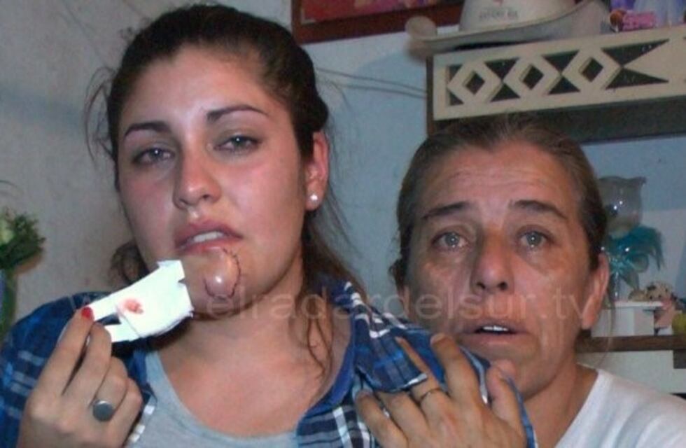 Se cruzó con su ex novio en un boliche de Florencio Varela y la atacó mordiéndole el mentón
