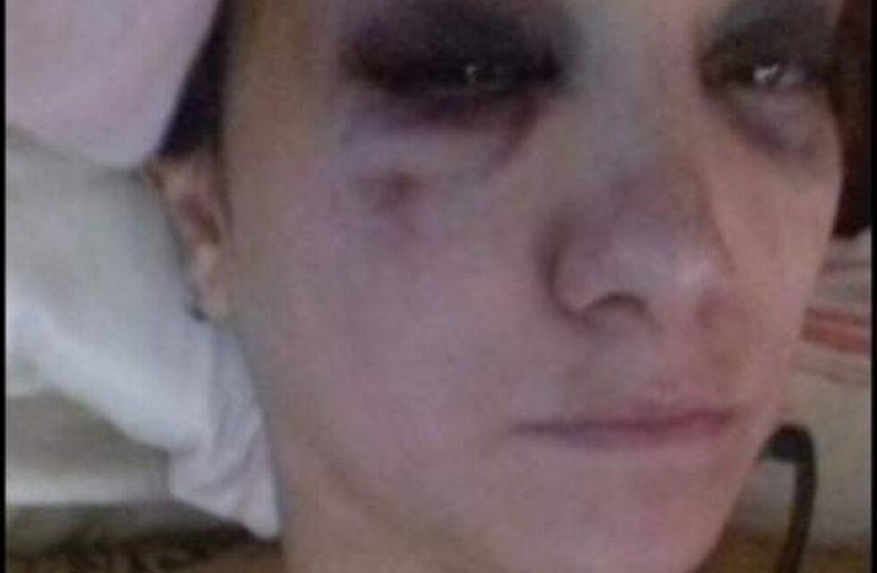 Mostró su rostro desfigurado y acusó a su ex de violencia de género
