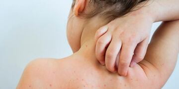 Comenzaron con el protocolo para evitar el brote de sarampión en Mendoza.