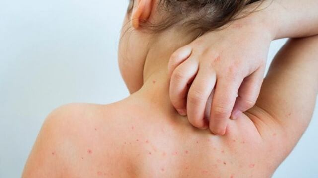 Comenzaron con el protocolo para evitar el brote de sarampión en Mendoza.