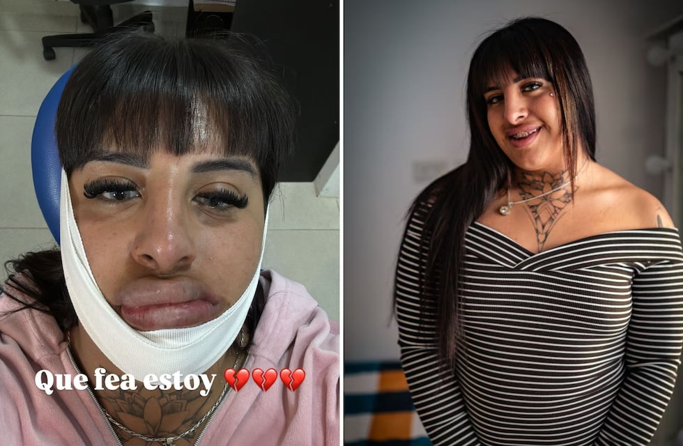 La Coqueta mostró el antes y después de su nuevo retoque en los labios y el resultado es impactante