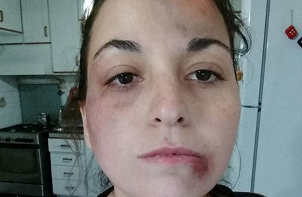 Denunció en redes la golpiza que le habría propinado su ex pareja