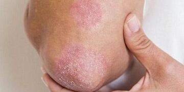 Realizan campaña en Neuquén para prevenir la psoriasis\u002E