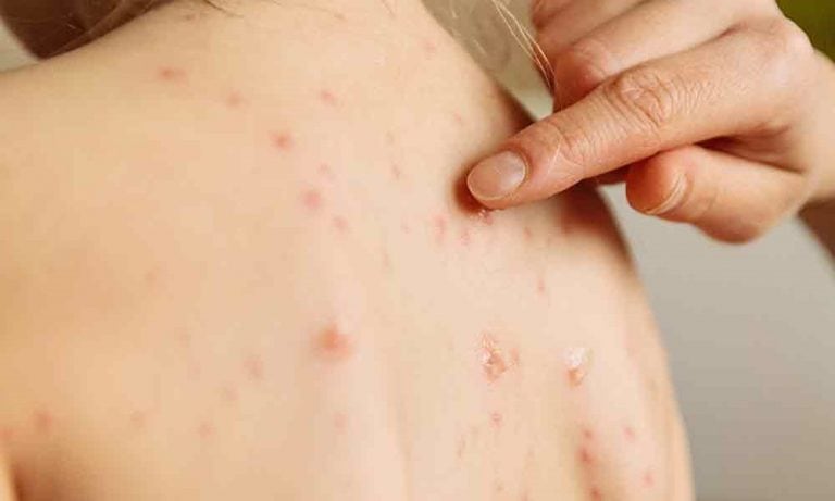 Brote de varicela en Entre Ríos