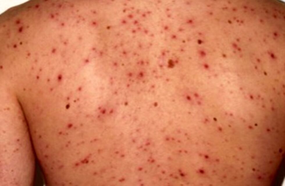 Alarma en una escuela de San Juan por un brote de varicela