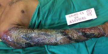 La piel de tilapia tiene muchas ventajas y ya revolucionó la medicina en Brasil\u002E