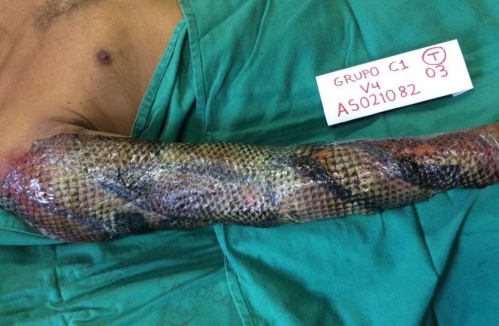 Usan la piel de un pez para curar quemaduras y reconstruir vaginas