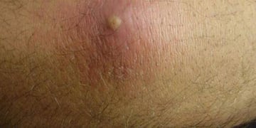 La infección en los humanos puede ser mortal, sobre todo en los niños.