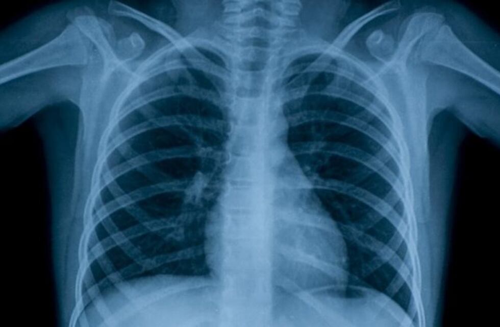 Confirman que hay 800 casos de tuberculosis por año en Salta