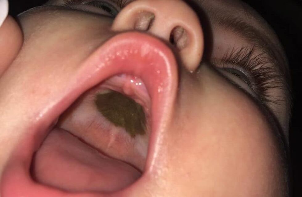 Descubrió una mancha en el paladar de su bebé, lo llevó al hospital y terminó avergonzada