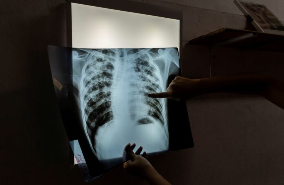 Hay dos casos de tuberculosis en una escuela de San Telmo