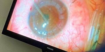 Realizan un transplante de córnea en Oberá